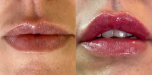 antes-depois5