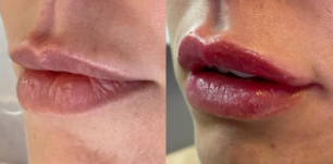 antes-depois6